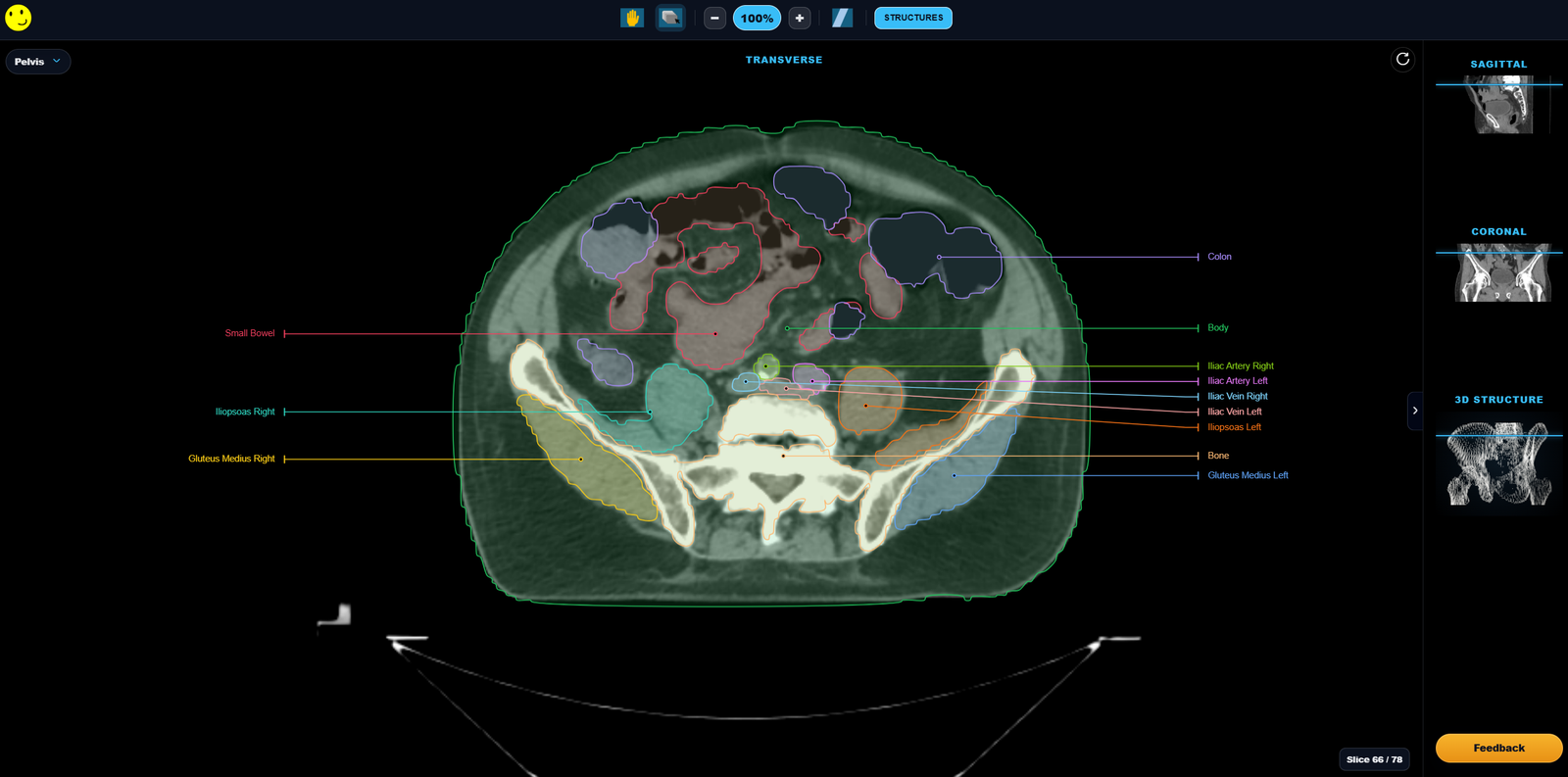 Labelled CT pelvis anatomy on RadBudd